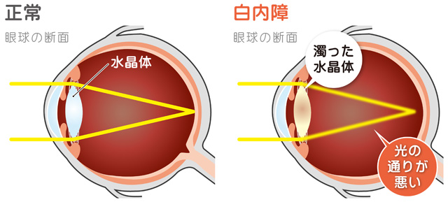 白内障はどんな病気？