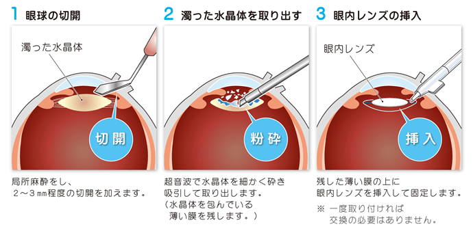 当院で行う日帰り白内障手術