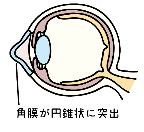 円錐角膜とは