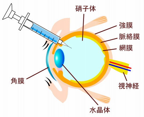 硝子体注射（抗VEGF療法）